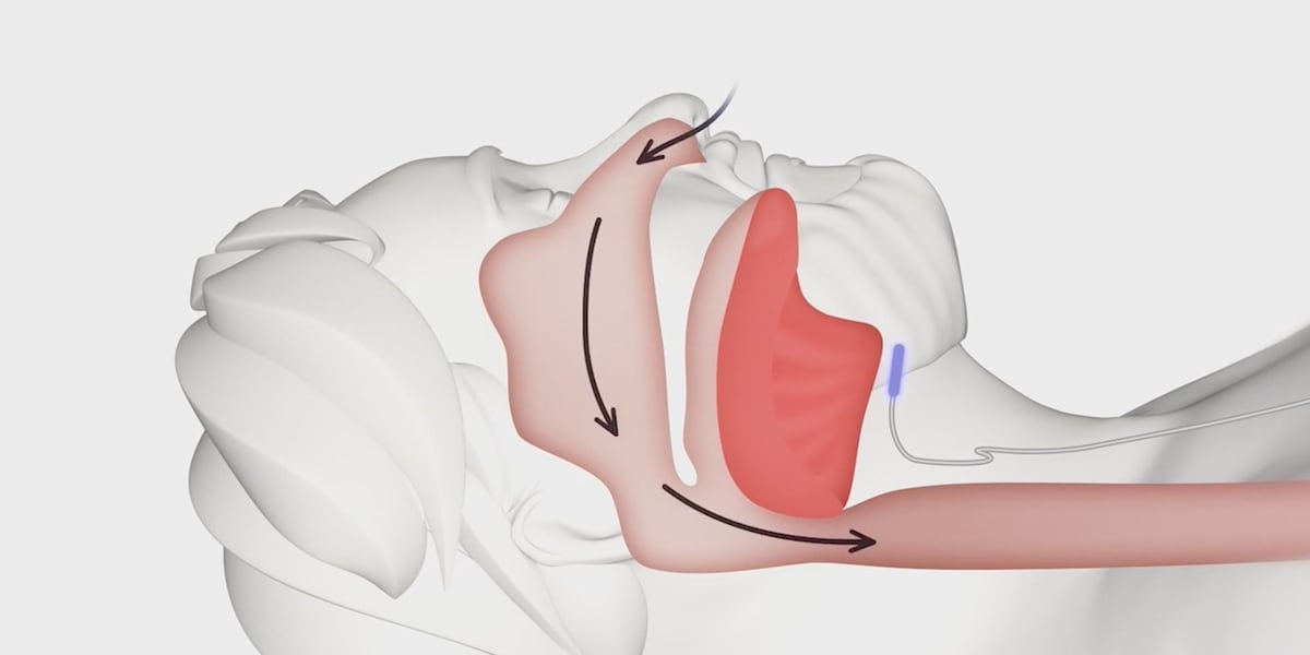 Breathe Easy: CHI Health Pioneers Revolutionary Surgery to Combat Sleep Apnea
